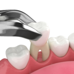 Long-Term Oral Health Benefits of Tooth Extraction in Los Angeles