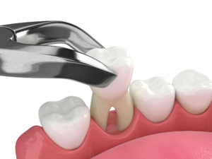 Long-Term Oral Health Benefits of Tooth Extraction in Los Angeles