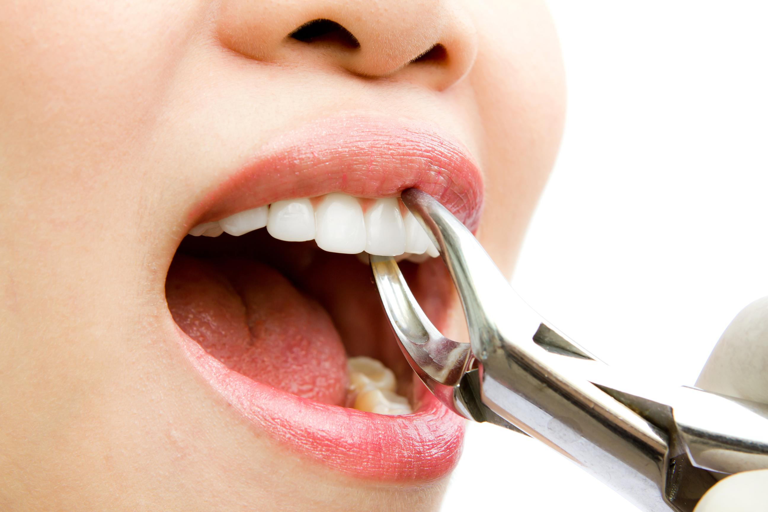 Tooth Extraction near me